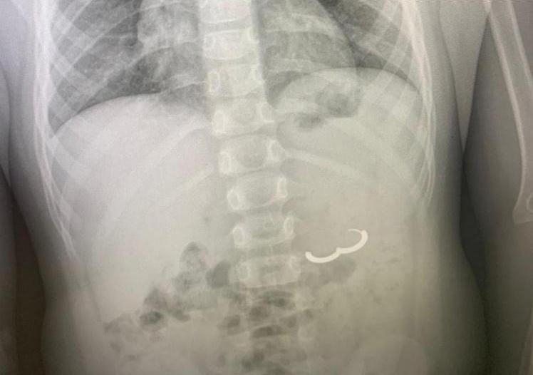 В Туапсе врачи извлекли из желудка малолетнего ребенка золотую серьгу